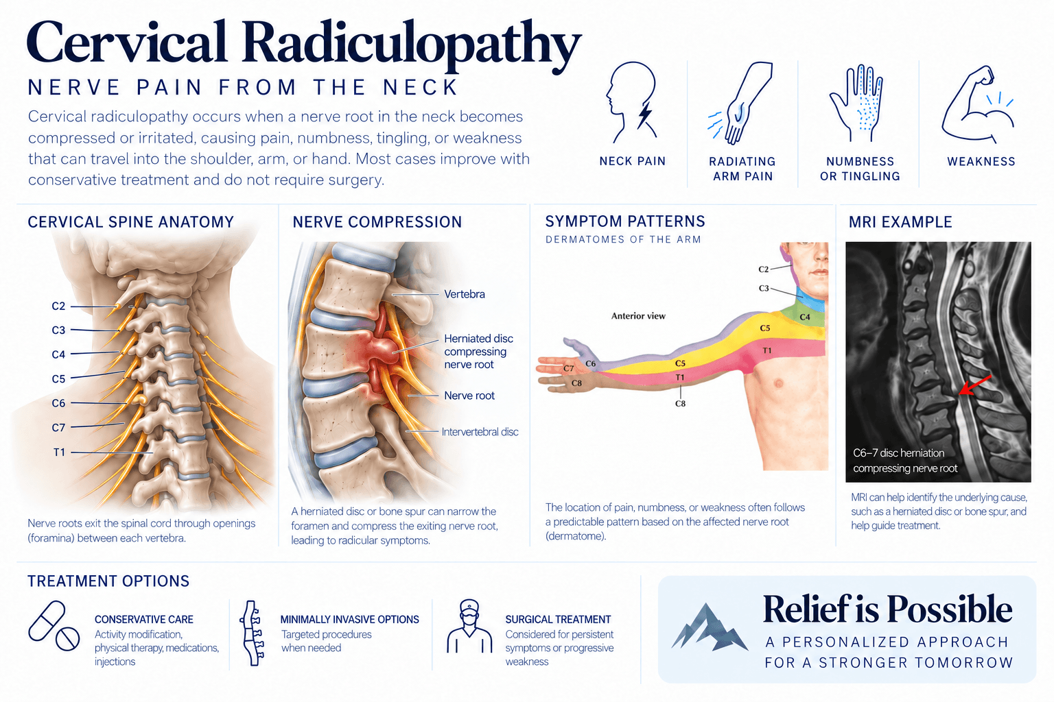 Infographic on cervical radiculopathy. A side view of the cervical spine labels the vertebrae from C2 to T1 and the nerve roots leaving between them, and a second panel shows a herniated disc narrowing that opening and pressing on one nerve root. A colour-coded arm shows which strip of skin each nerve root supplies, and an MRI beside it marks a C6 to C7 disc herniation compressing a root. Further panels list the common symptoms, neck pain, radiating arm pain, numbness or tingling, and weakness, and the treatment options, from conservative care through minimally invasive procedures to surgery.